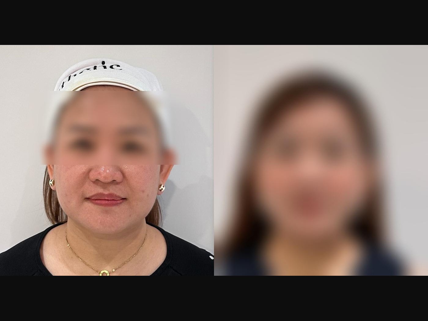 VF Facelift - Sculpts Lower Face Lessens Excess Puffiness